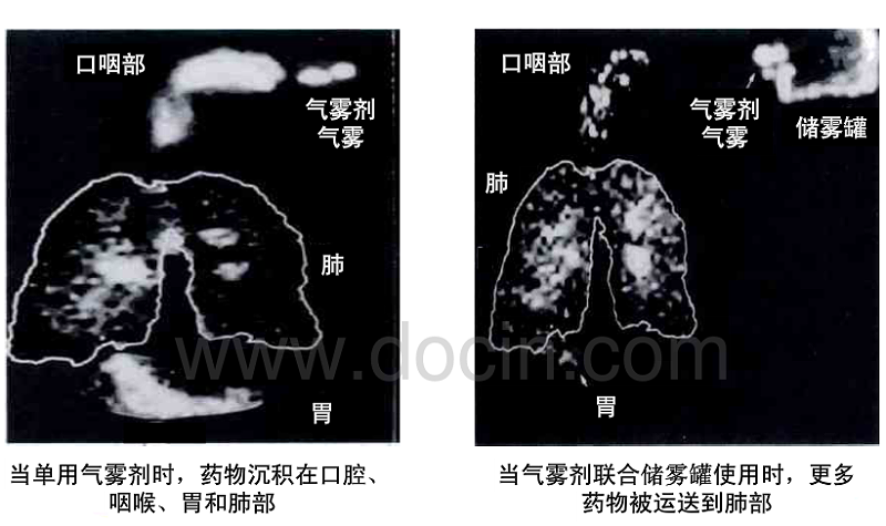 氣霧劑結合氣霧罐使用時治療效果更佳